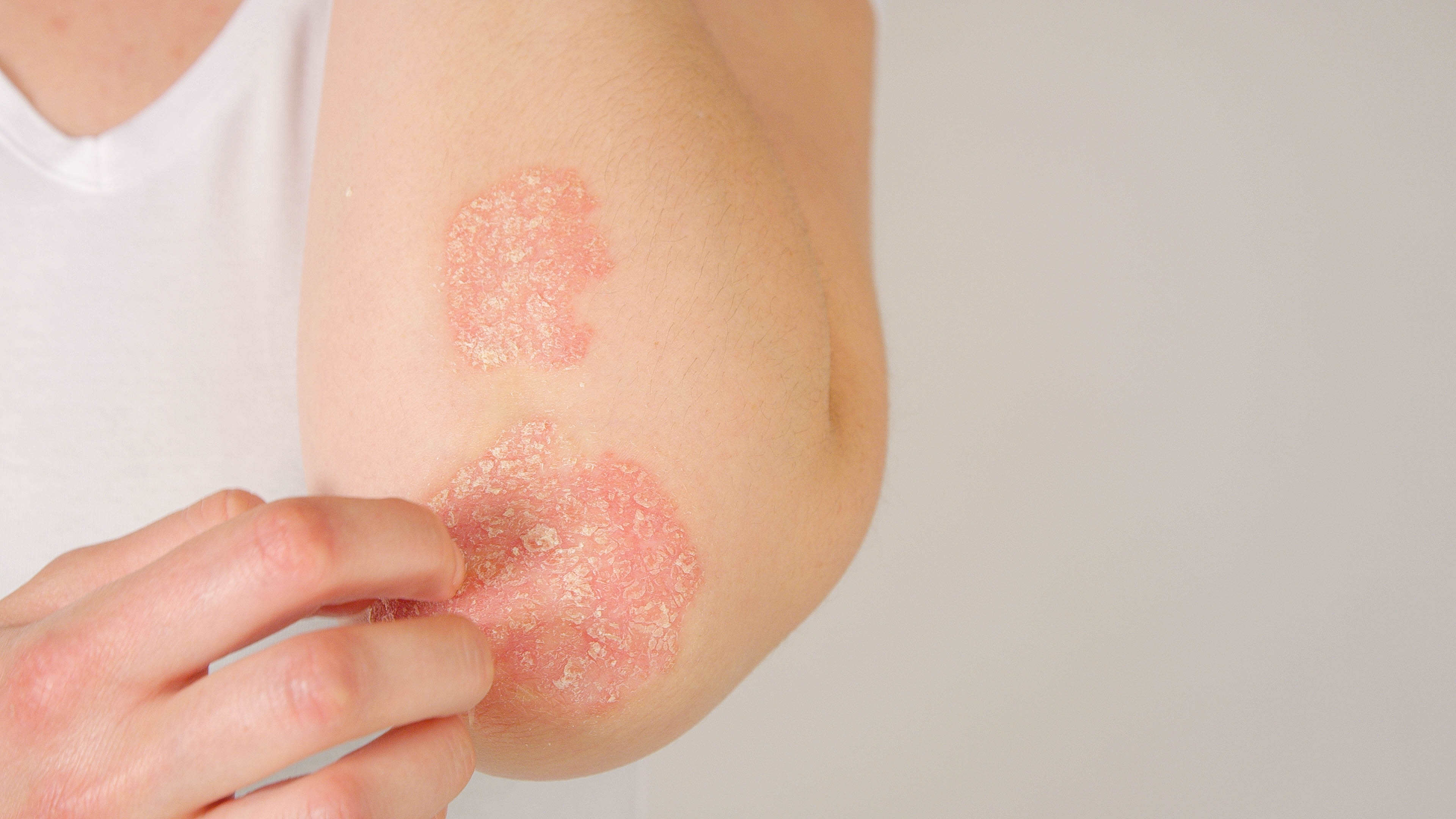 Close up shot of a person touching the psoriasis on their elbow