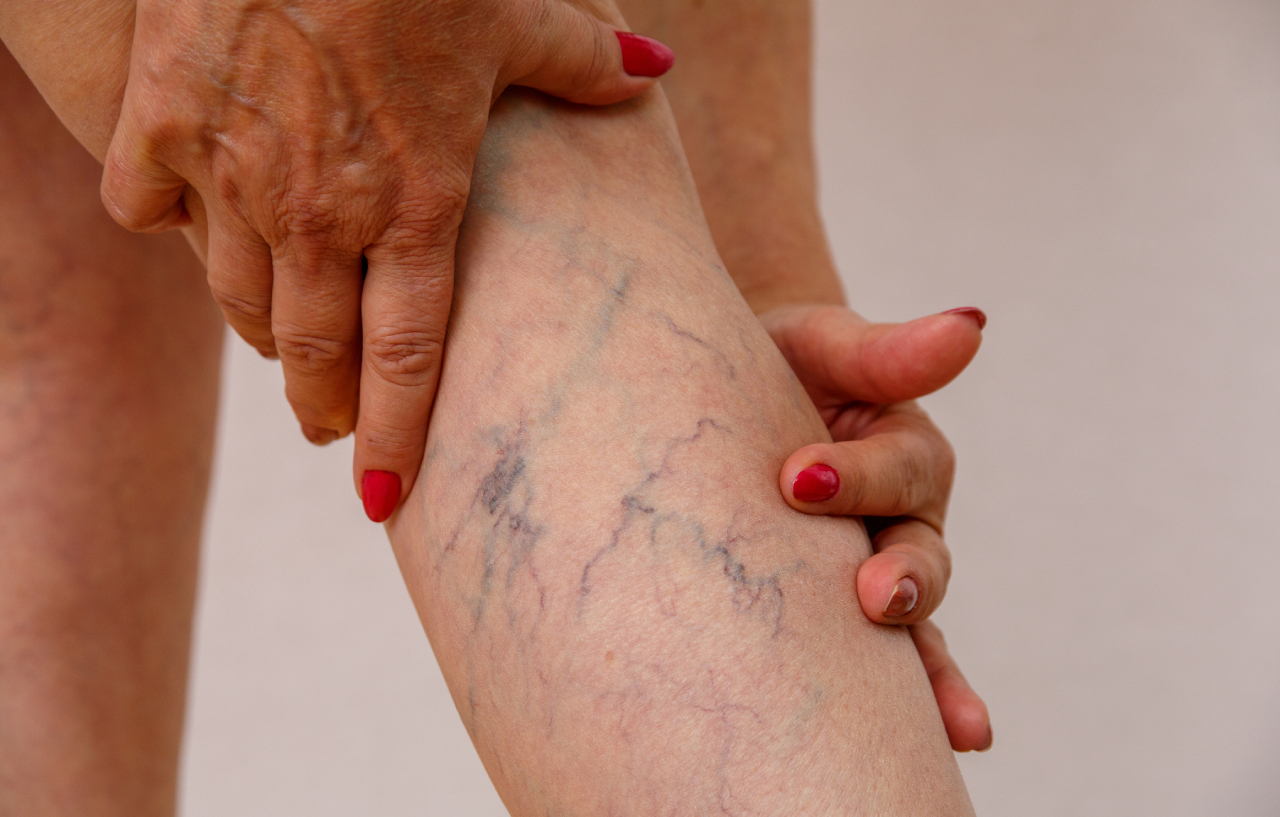 Woman's leg with varicose veins before her VNUS procedure (Venefit)