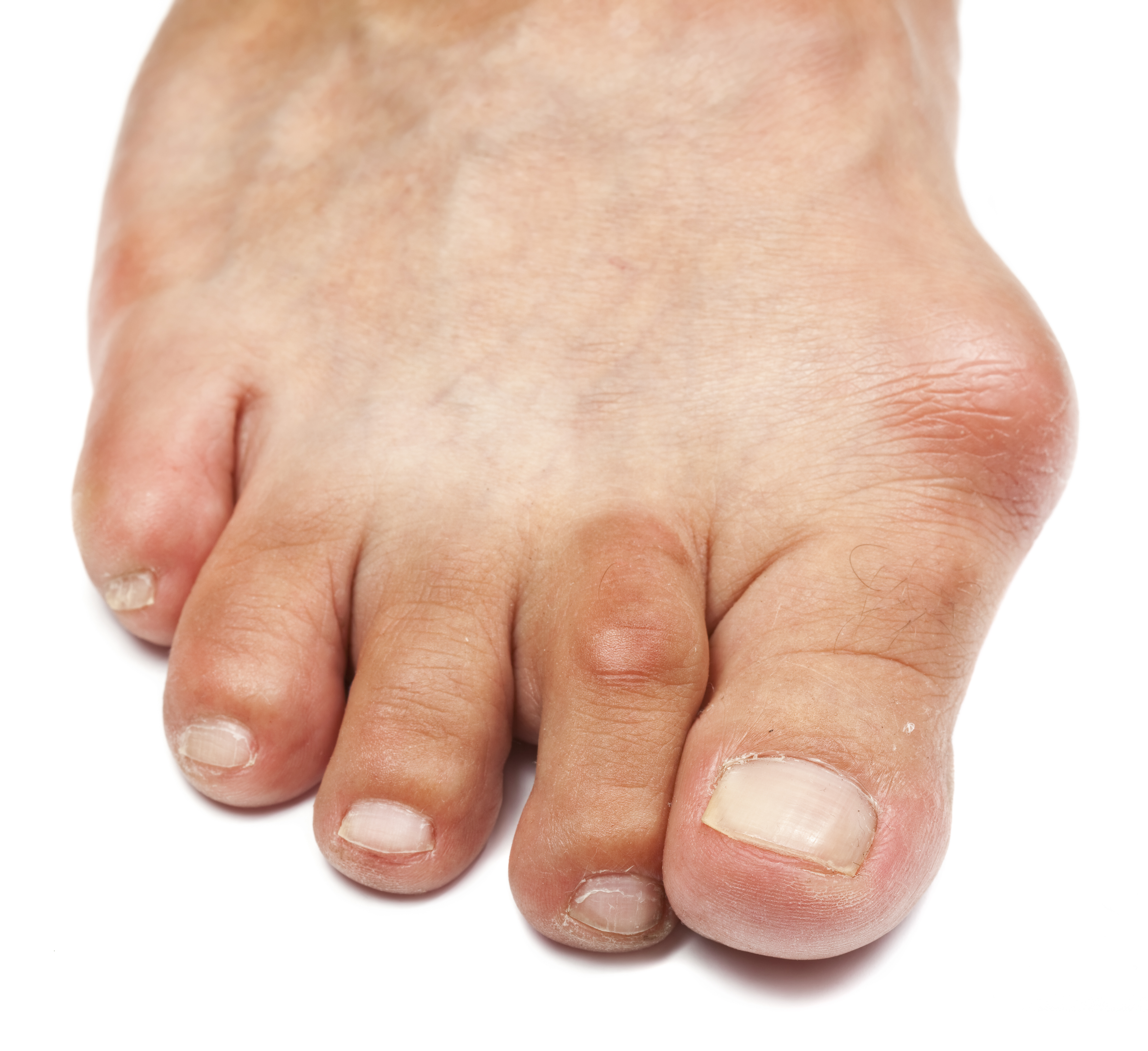 Crossover toe and a large bunion on a foot