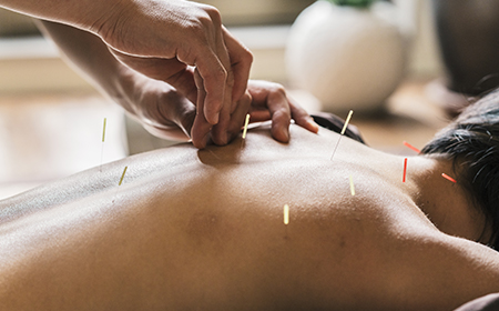 patient receiving acupuncture