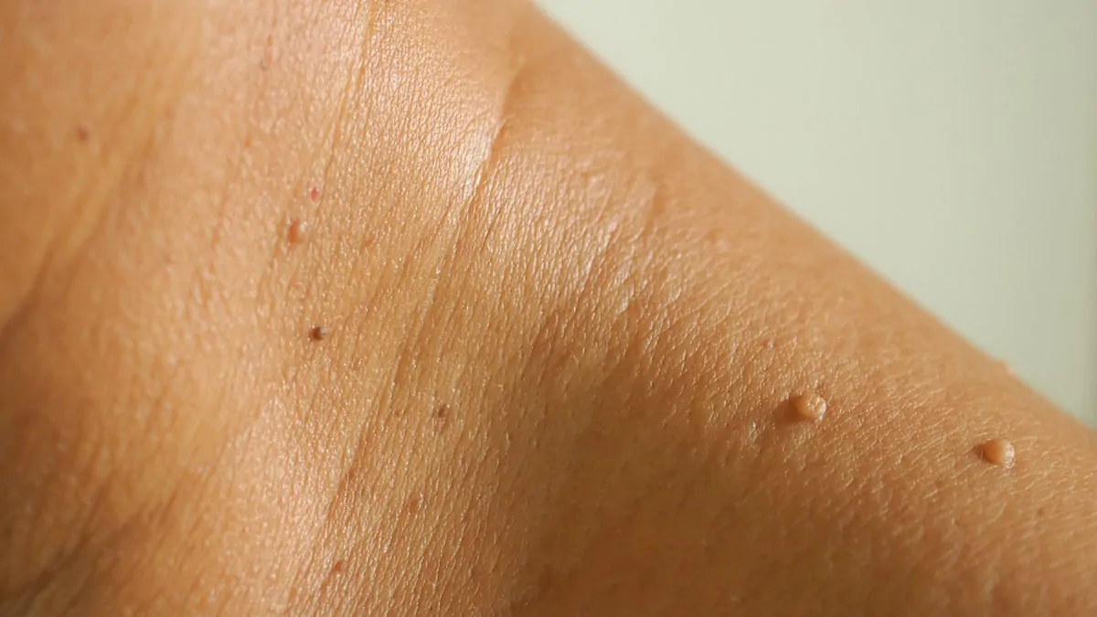 Skin tags on a neck