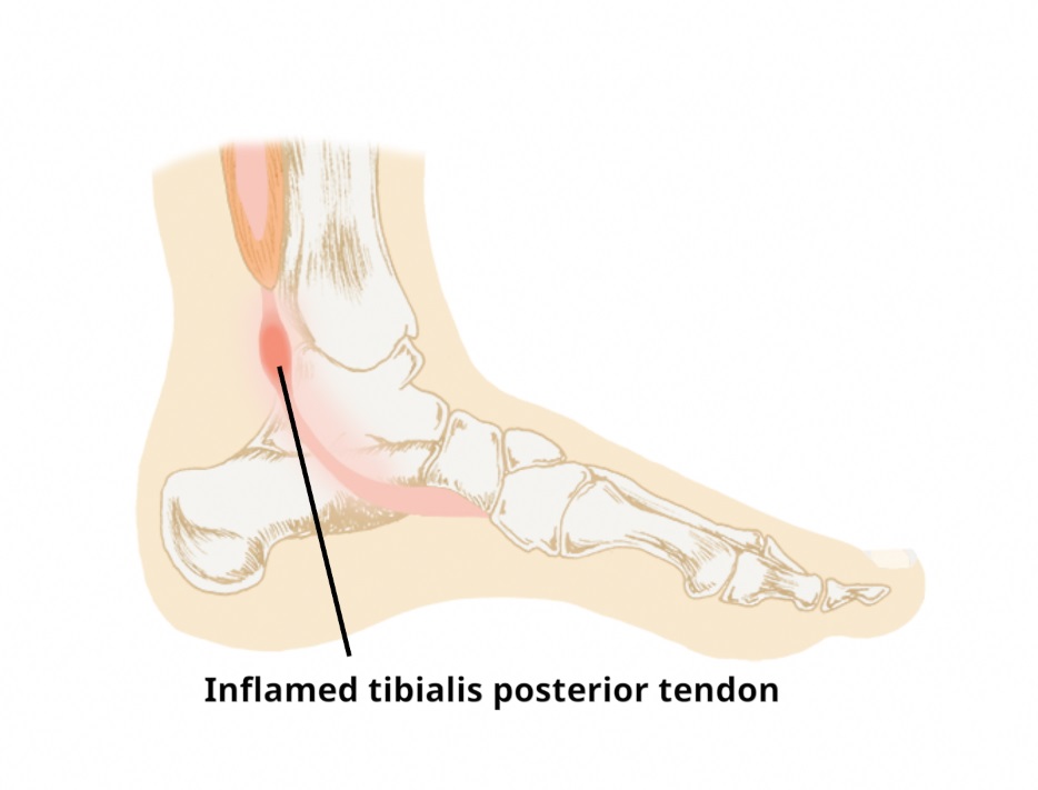 tibialis posterior tendinopathy