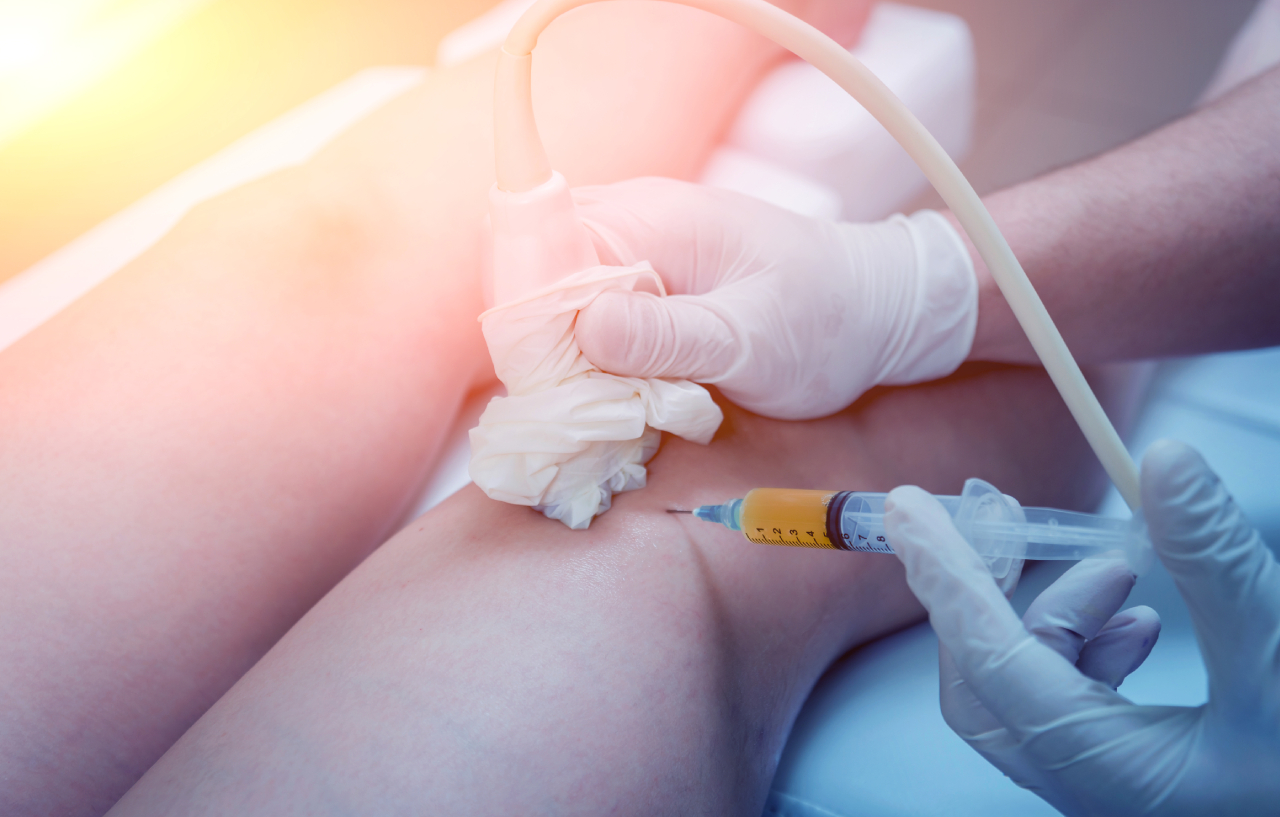 Ultrasound-guided-platelet-rich-plasma-injection-of-the-knee